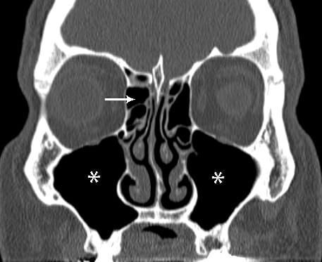 Adult Sinusitis - SinusHealth.com