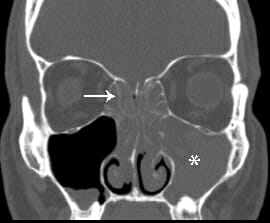 Adult Sinusitis - SinusHealth.com