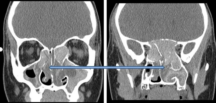 Fungal Sinusitis - SinusHealth.com