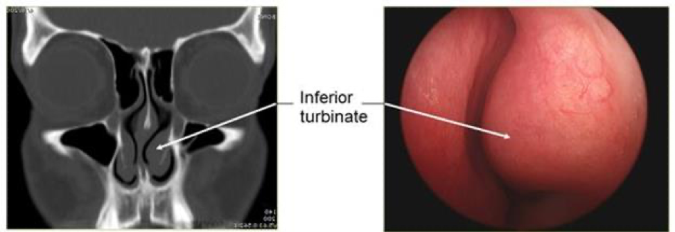 Septoplasty And Turbinate Reduction 3449